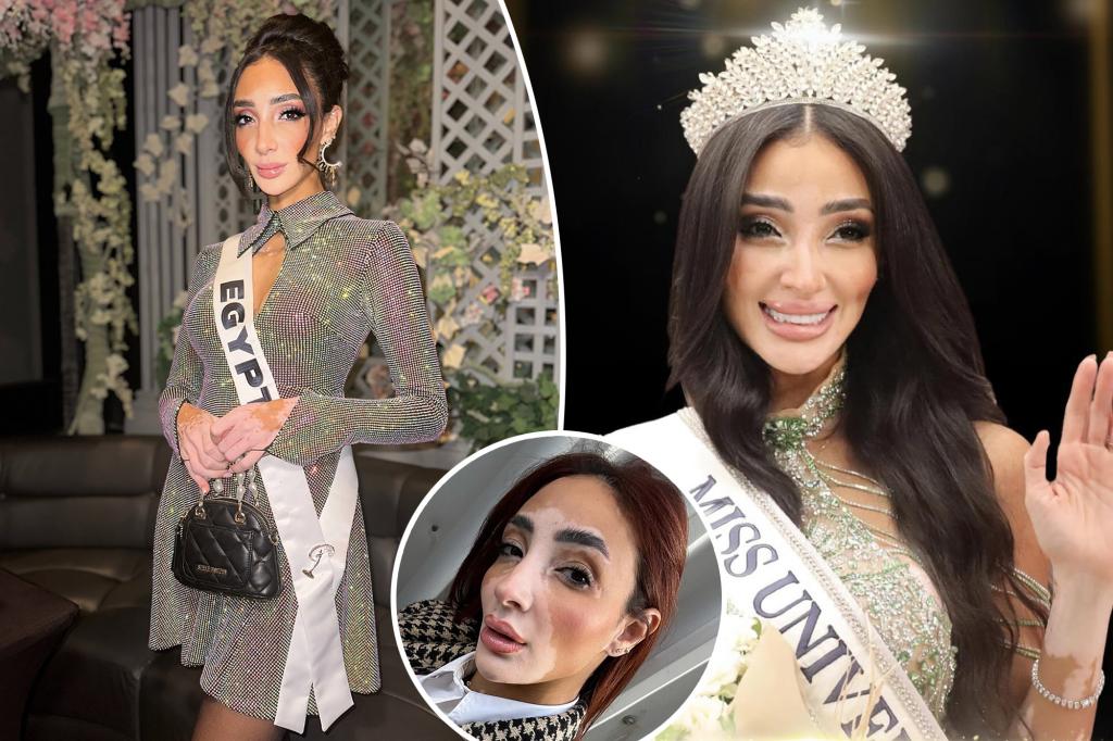 Miss Universe contestant with vitiligo, lupus aims to win pageant, make history: 'Embodiment of inclusiveness'